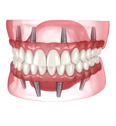 teeth implants near me