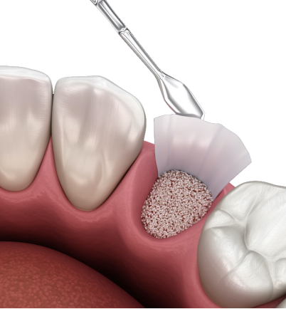 Guided Bone Regeneration
