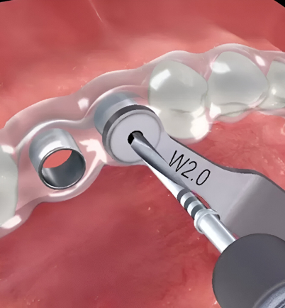 specialist dental implants