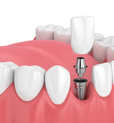 best dental implants