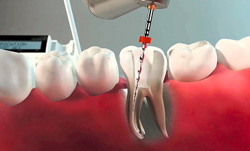 Cleaning and Shaping the Root Canals