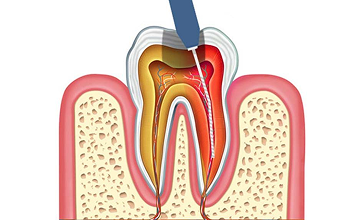 Complete Pulp Removal