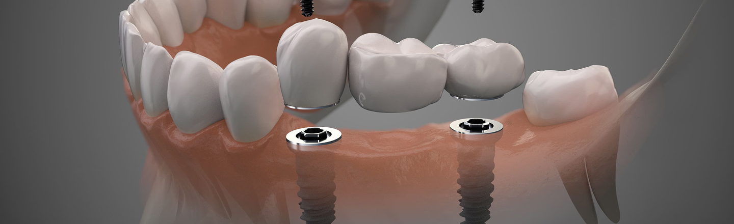 Dental Implant Centre