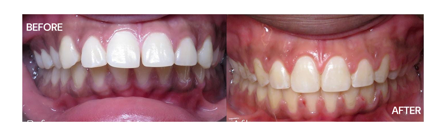 Bite Correction - Before and After