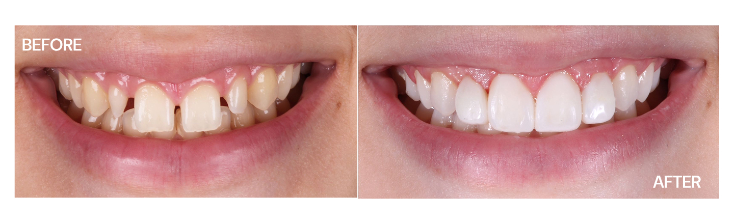 Spacing - Before and After