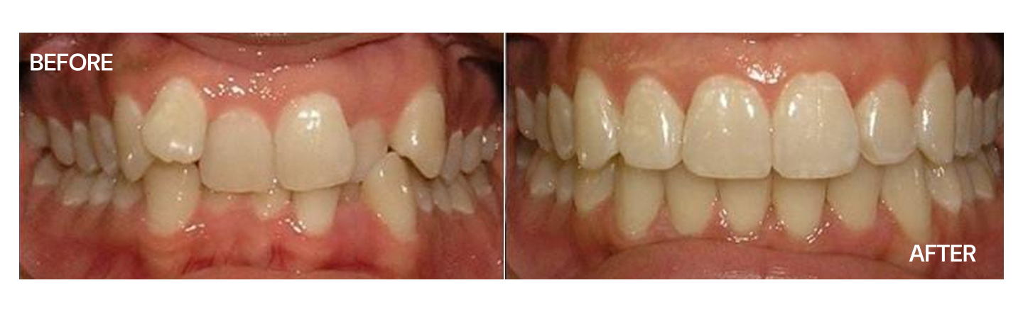 Teeth Crowding - Before and After