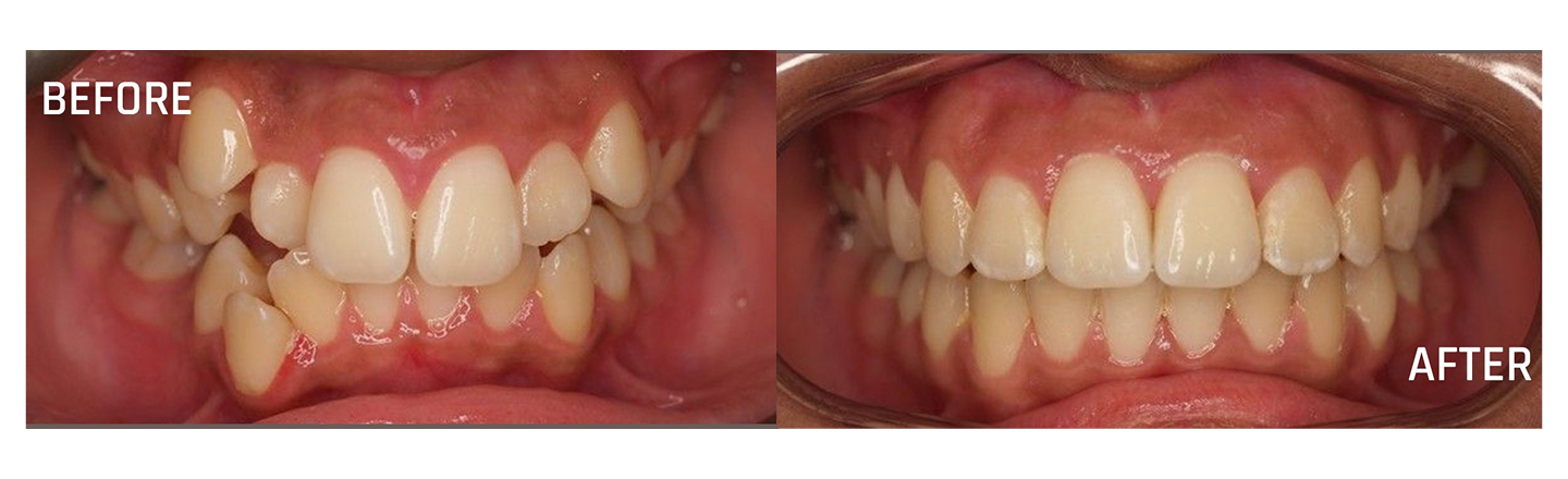 Tooth Alignment - Before and After