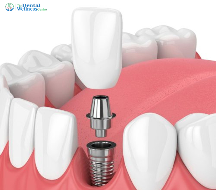 Dental Implants