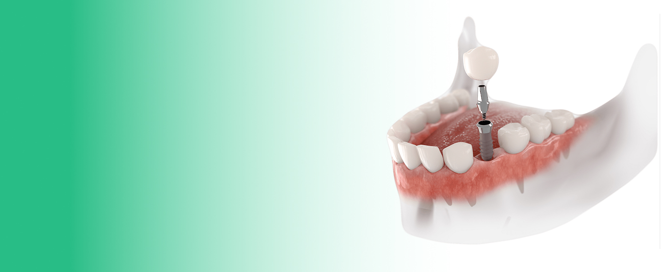 Why Dentists Recommend Dental Implants Over Traditional Bridges