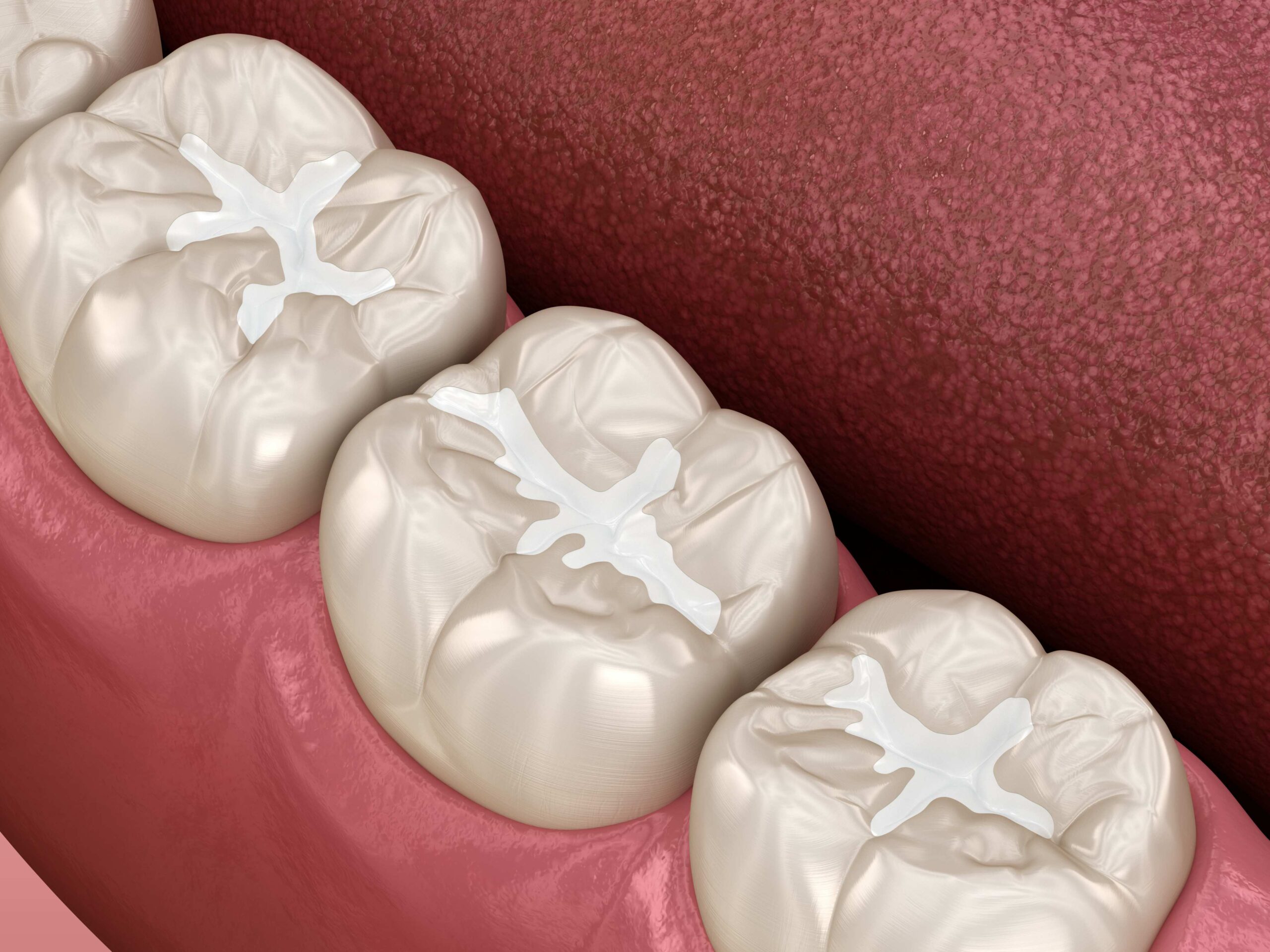 Dental Sealants