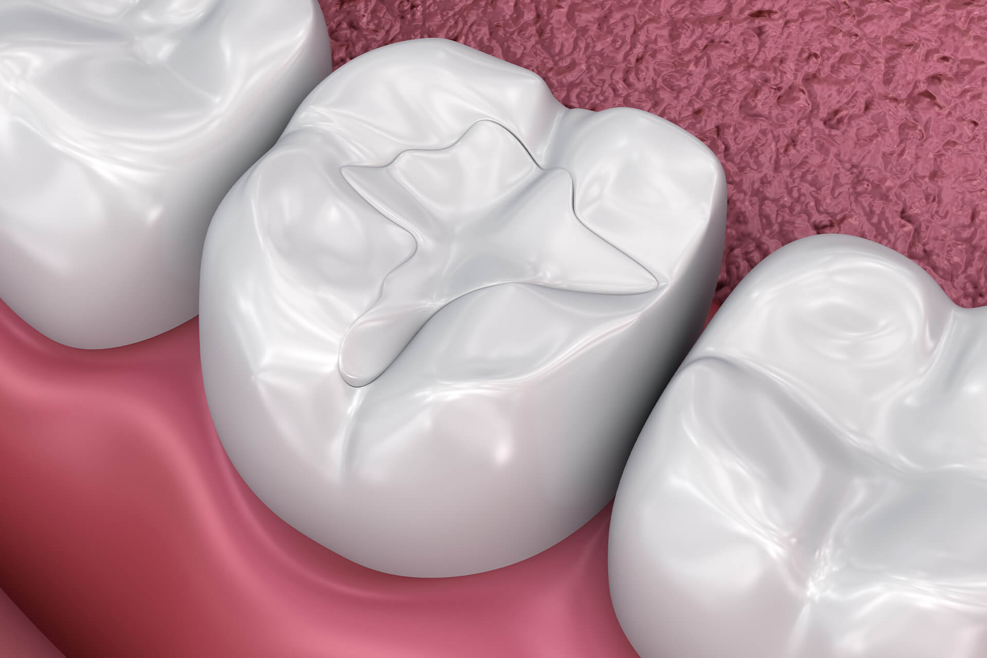 Tooth Color Filling