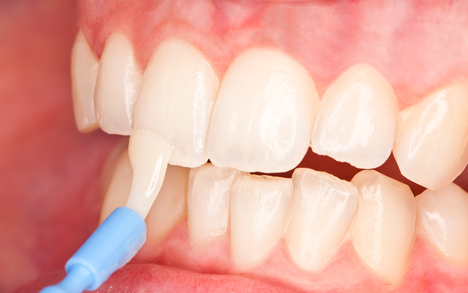 Fluoride Treatment