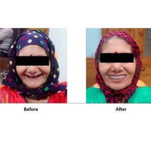 Full Mouth Reconstruction