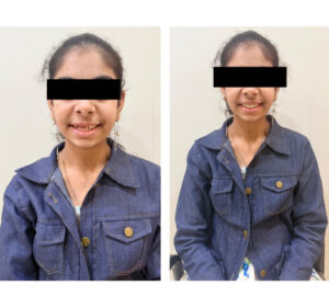 Multiple Missing Teeth
