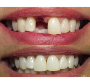 Single Tooth Implant