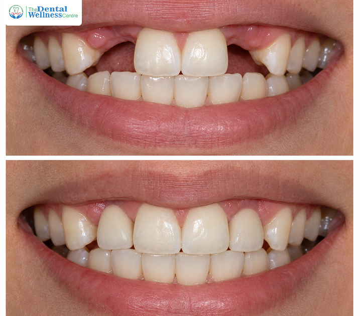 Dental Implants Before and After: Real Transformations