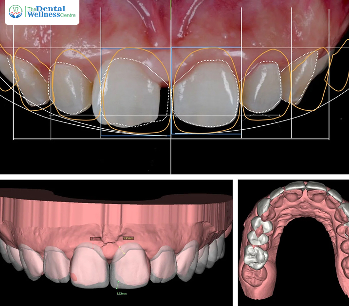 How Digital Dentistry Makes Dental Implant Treatment More Accurate