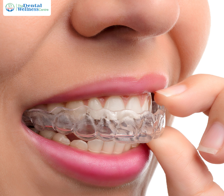 Clear Teeth Aligners