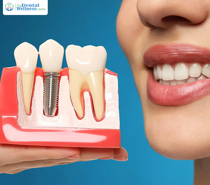 Dental Implants in Ahmedabad
